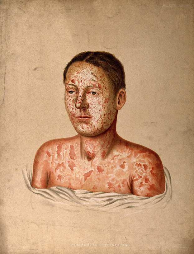 Ein Mann mit roten Flecken im Gesicht und auf der Brust, was eine Darstellung von Hautkrebs darstellt.